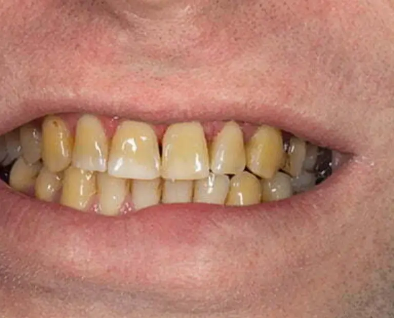 Antes